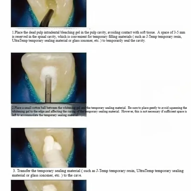 Dental Oral Restoration Materi - Teeth Whitening Effects recension och pris