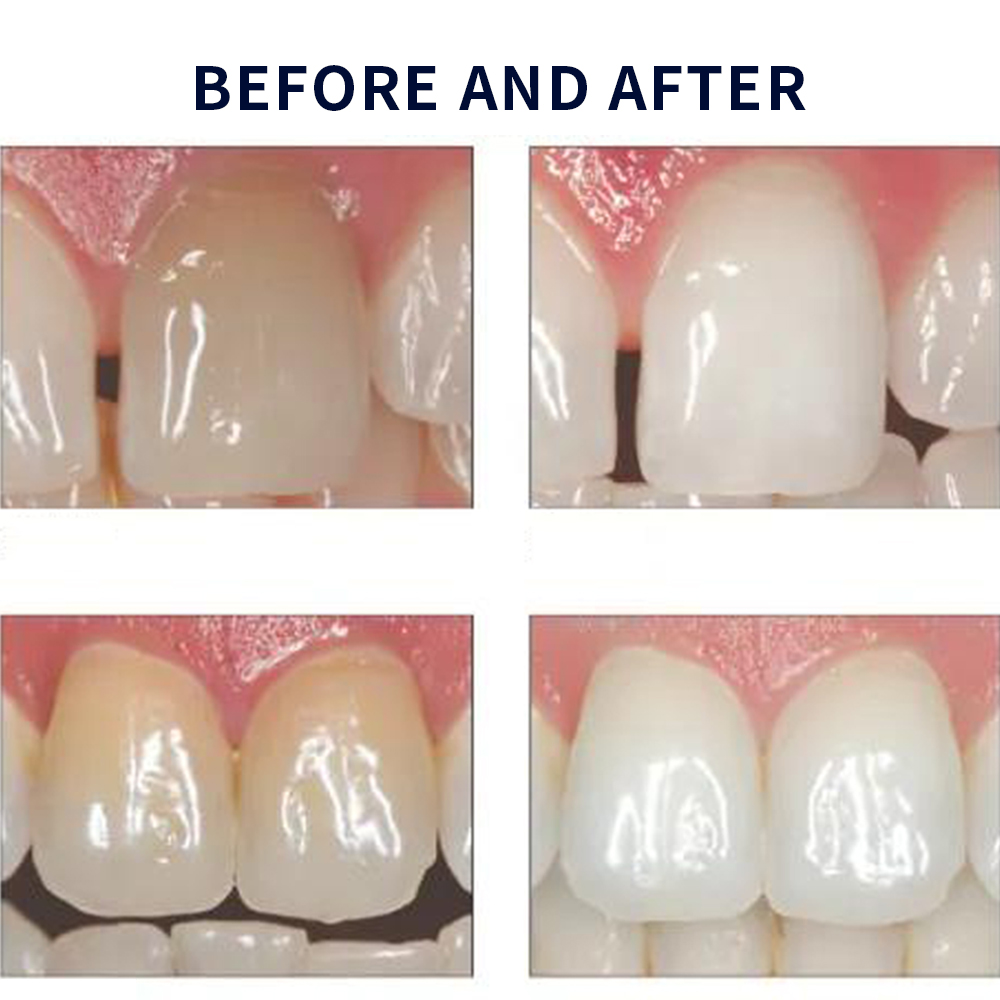 Opalescence Whitening 20% PF 2 - Teeth Whitening With Hydrogen Peroxide recension och pris