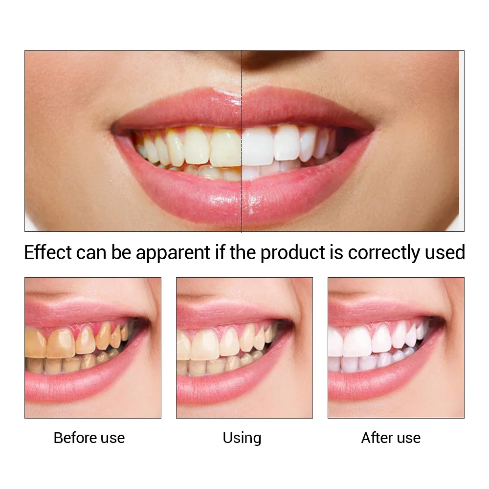 FTEENPLY Teeth Whitening Essen - Teeth Whitening Session recension och pris