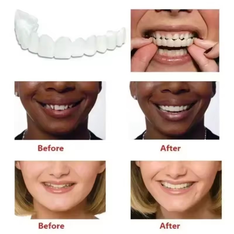 Teeth Veneers Whitening Dentur - Teeth Whitening Session recension och pris