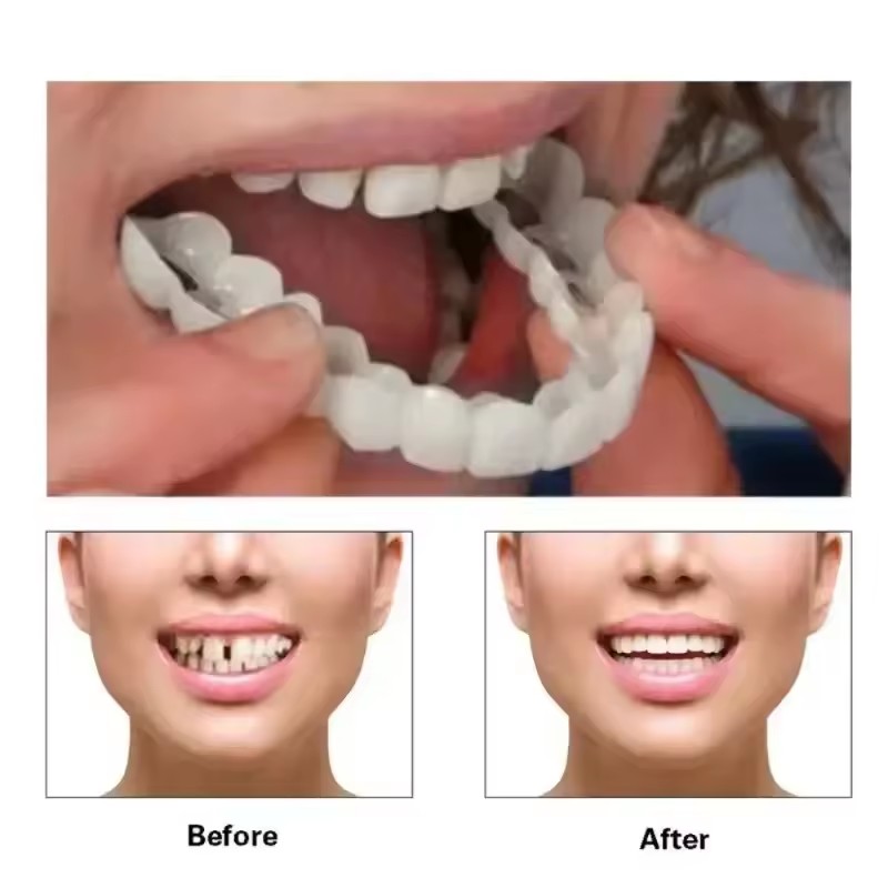 Teeth Veneers Whitening Dentur - Teeth Whitening Session recension och pris