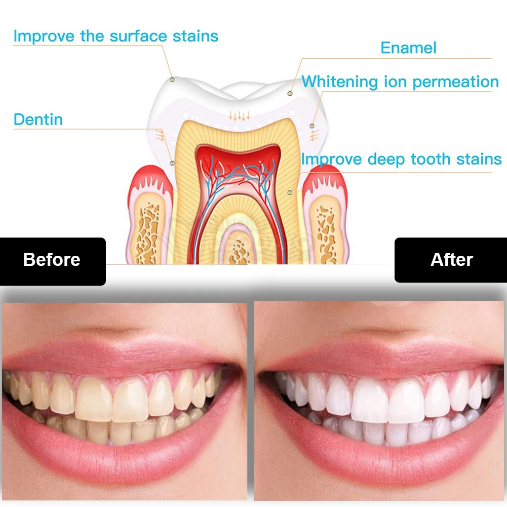 Dental Teeth Whitening Kit Min - Teeth Whitening With Hydrogen Peroxide recension och pris
